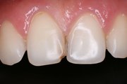 Стоматология. Лечение переднего зуба